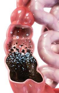 Gunk, waste and toxins in the colon