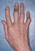 arthritis in hand