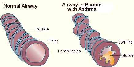 Restricted Airways