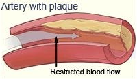 hardening of the arteries