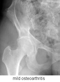 mild osteoarthritis