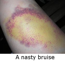nasty bruise