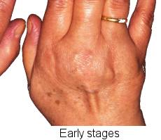 arthritis in the hand and fingers