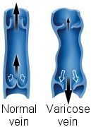 varicose veins picture